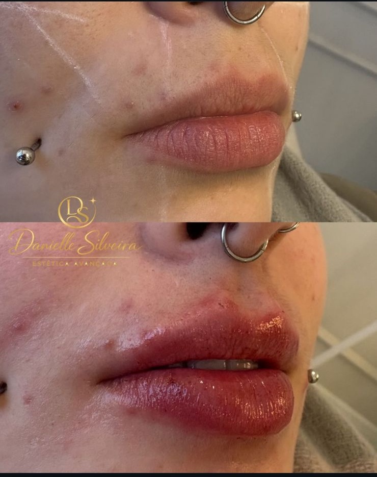 Antes e depois de preenchimento labial